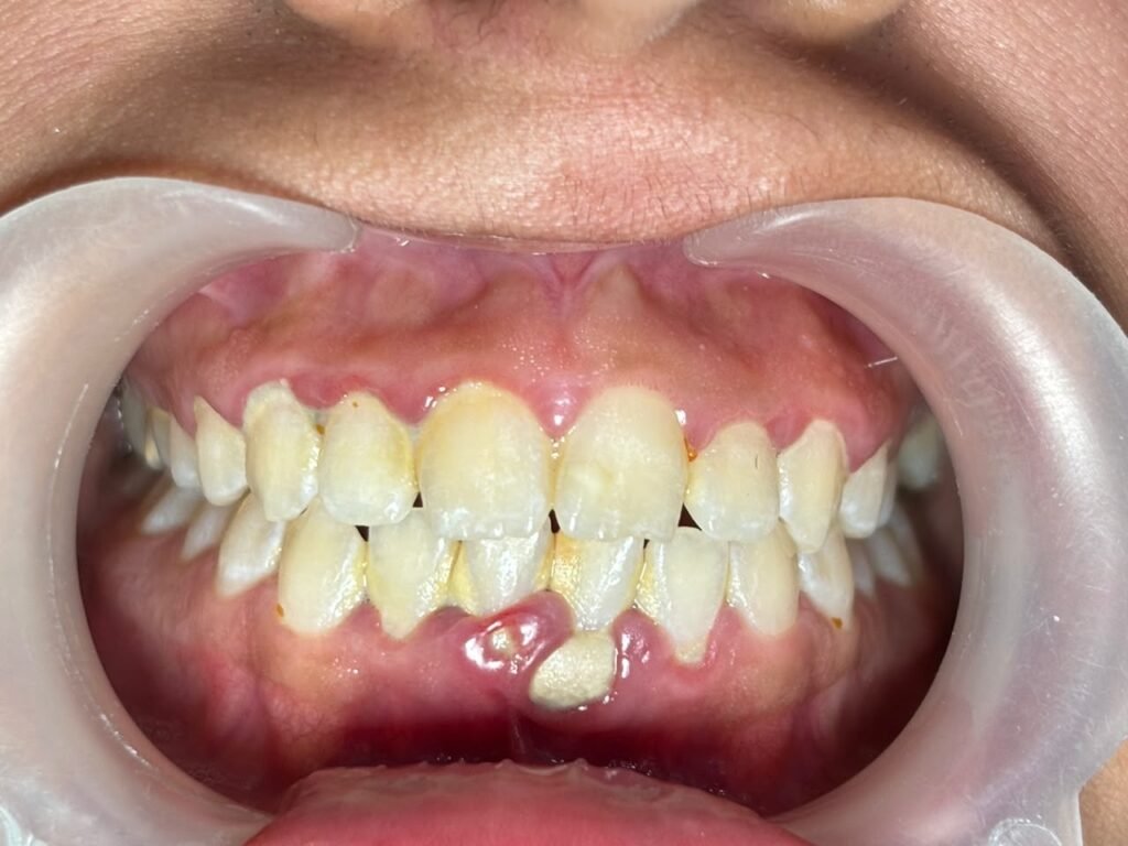 Plaque and tartar buildup along the gum line with inflamed gums