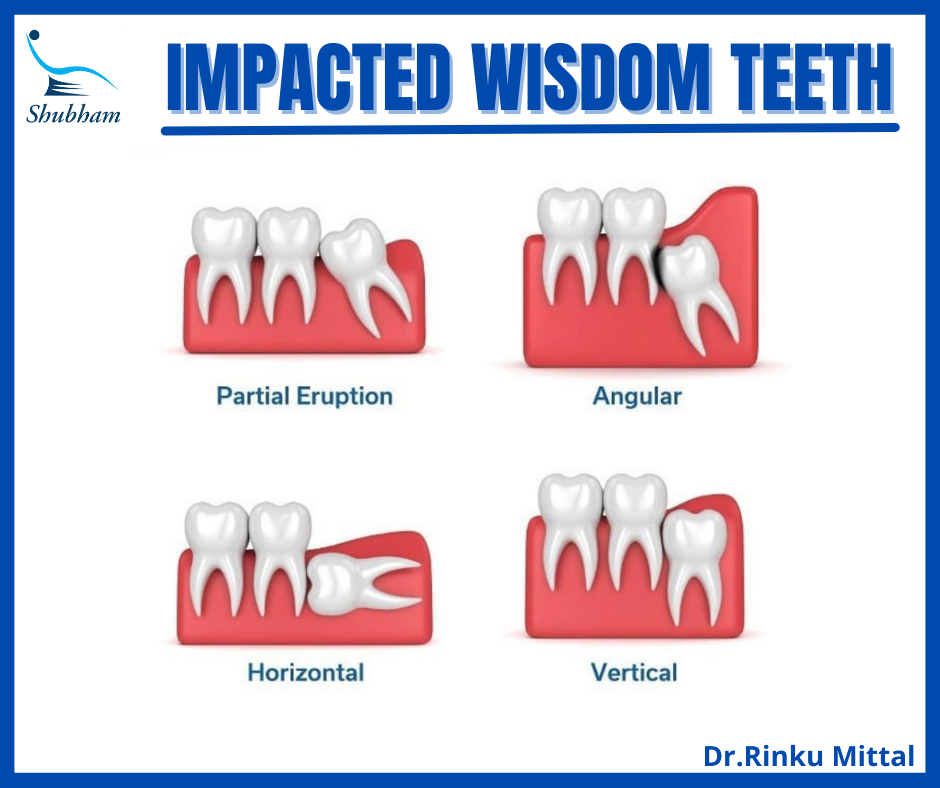 TYPES OF WISWHAT TO EXPECT WHEN GETTING YOUR WISDOM TOOTH REMOVEDDOM TOOTH IMPACTION|