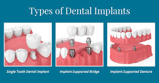 Dental implants at Shubham dental clinic in Hisar|