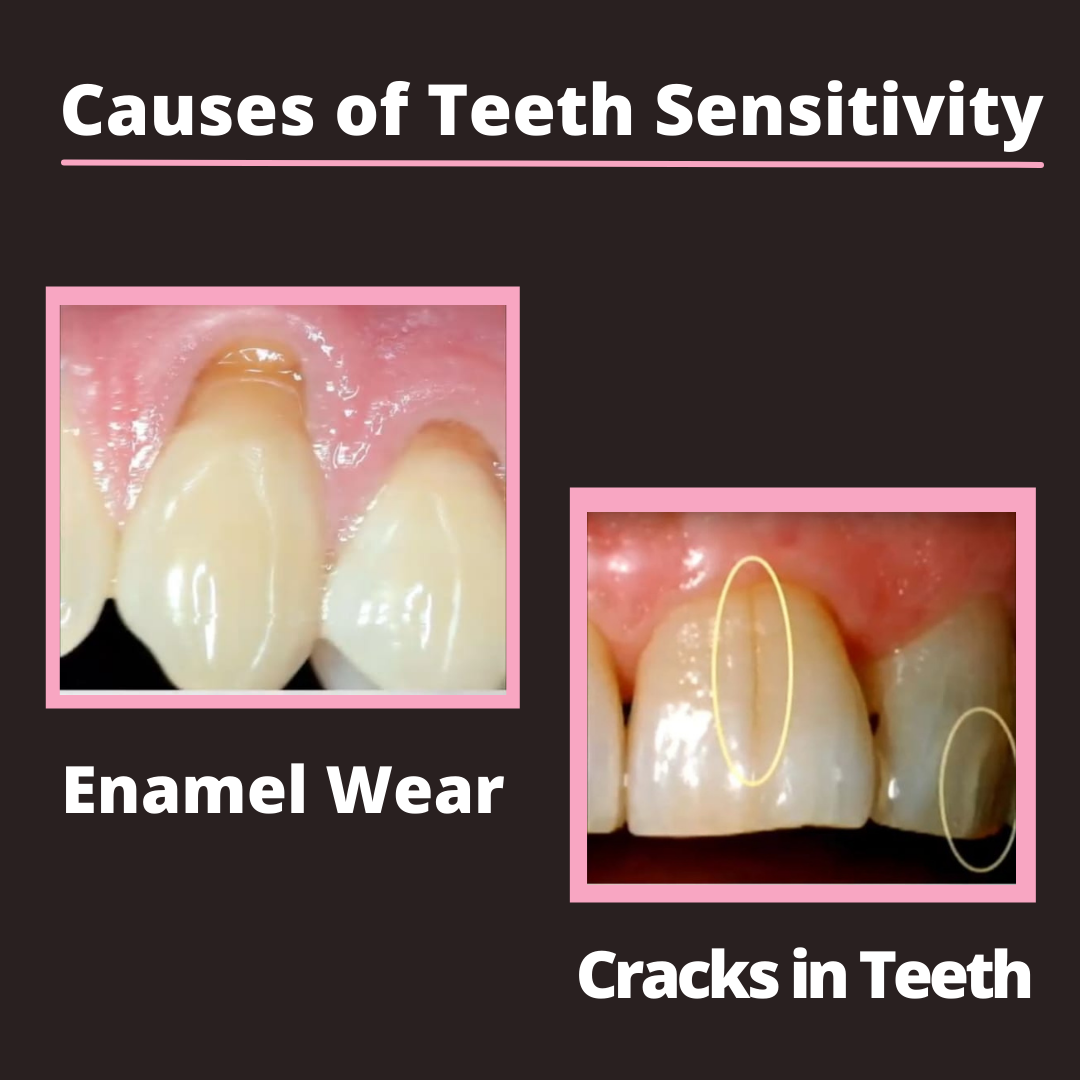 Teeth Sensitivity causes, treatments, and home remedies
