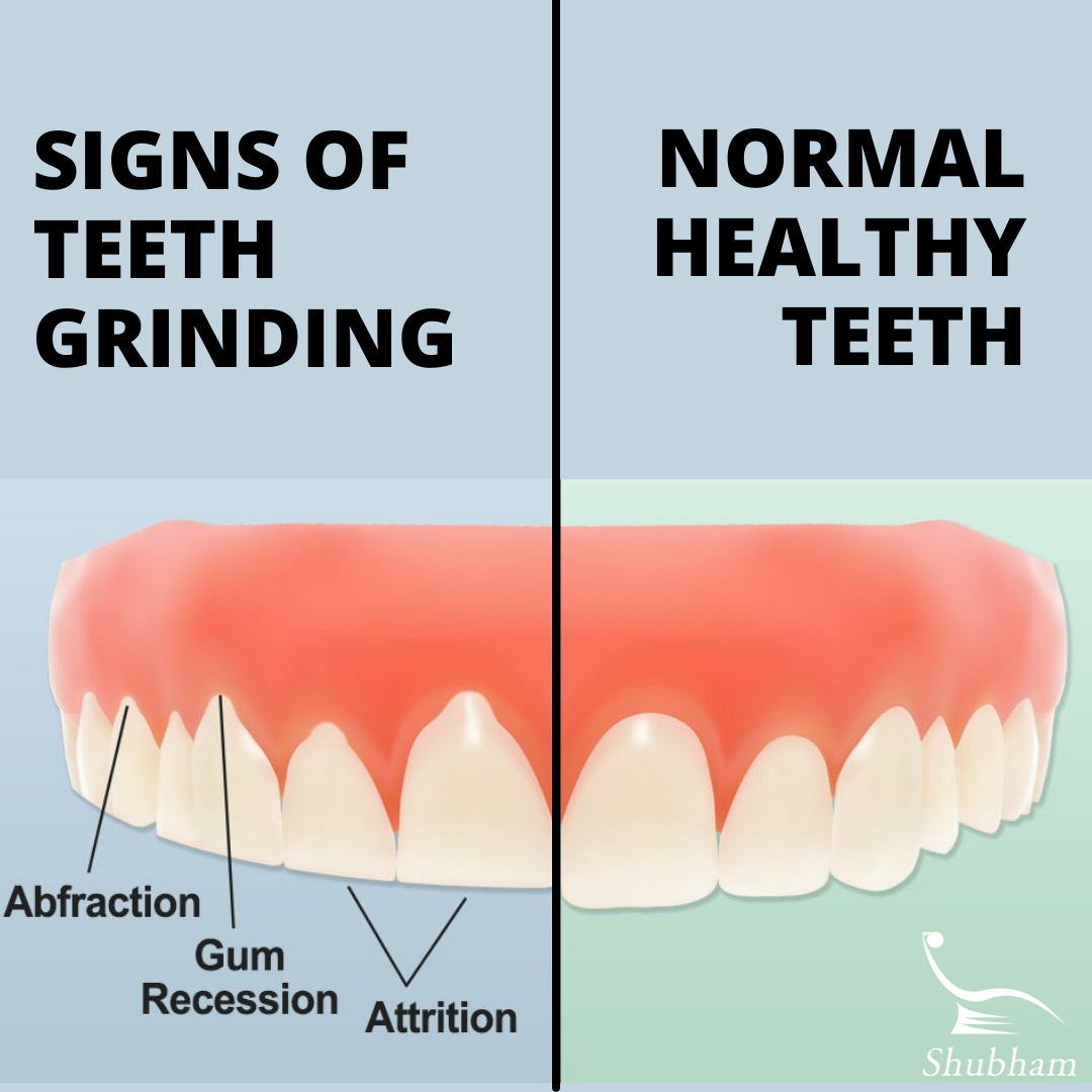 Bruxism or Teeth Grinding- Causes, Symptoms, and Treatment - Shubham ...