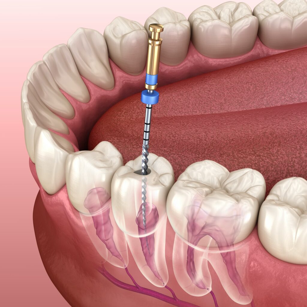 Root Canal Treatment- Shubham Dental Clinic in Hisar