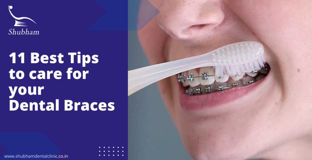11 Best Tips to Care For Your Dental Braces- Dental braces