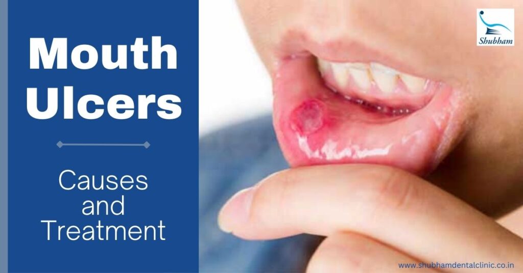 Mouth ulcers-causes and treatment, dental clinic in hisar, dentist near me, dental clinic near me, dentist in Hisar, causes of mouth ulcers, oral ulcers, treatment of mouth ulcers