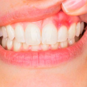 Teeth cleaning and polishing in Hisar
Dental scaling and polishing near me
benefits of scaling and polishing
Shubham dental clinic Hisar
Prevent gum disease by teeth cleaning