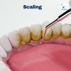 Teeth cleaning | scaling near me| best dentist in Hisar| best teeth cleaning near me| Scaling and polishing |teeth whitening in Hisar| dental cleaning|