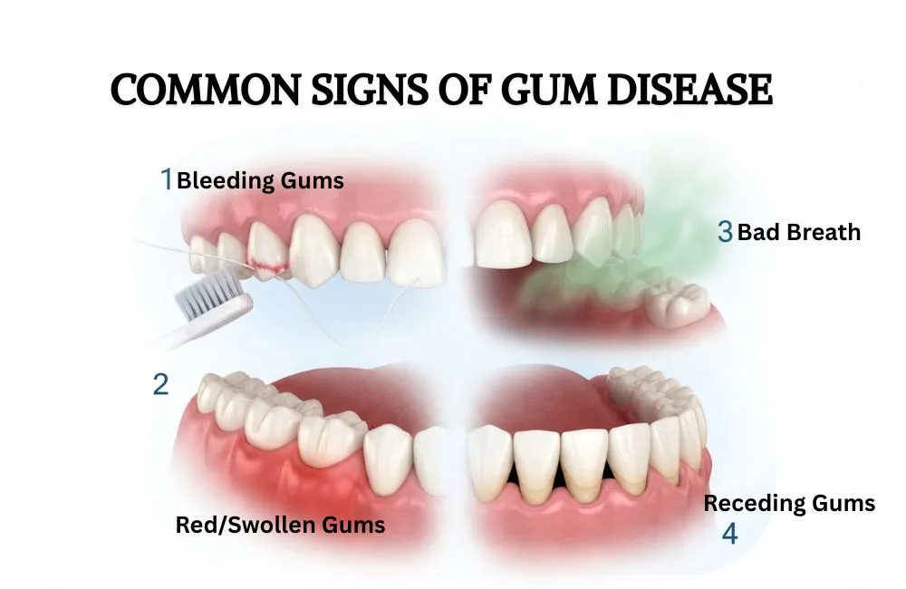 Illustration showing common signs of gum disease including bleeding, swollen gums, bad breath and receding gums.
