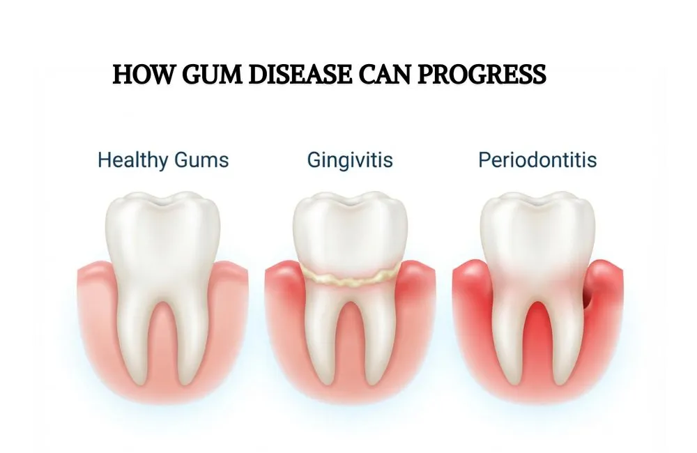 Illustration showing healthy gums, gingivitis and periodontitis