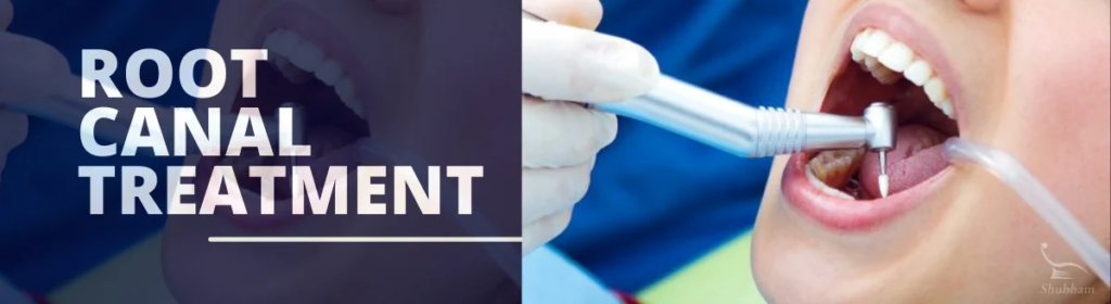 Root canal treatment in Shubham Dental Clinic Hisar